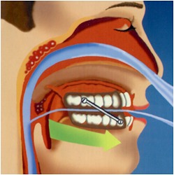Schnitt mit Anti-Schnarch-Gerät Schnitt mit Anti-Schnarch-Gerät